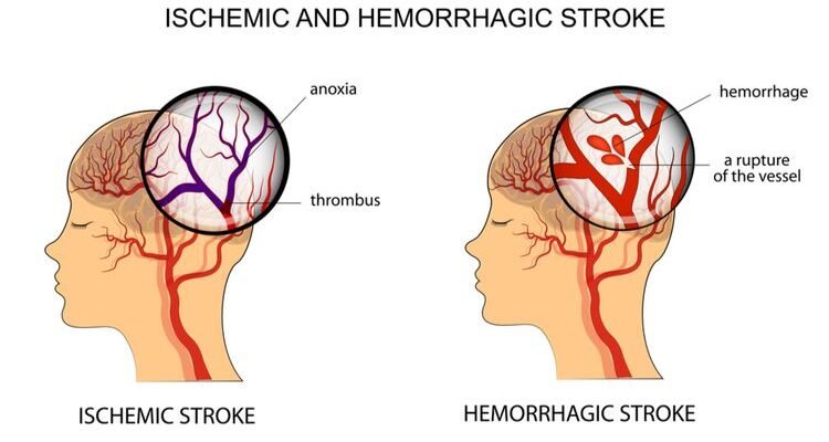 Mengenal Stroke Iskemik