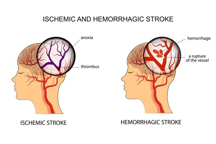 Mengenal Stroke Iskemik